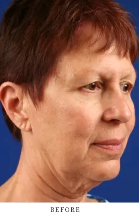 Facelift & Neck Lift Before & After Case 5.1 Results images
