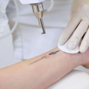 Laser Tattoo Removal in Springfield Banner