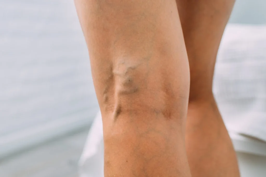 What Are the Causes of Varicose Veins and How to Prevent Them? Banner
