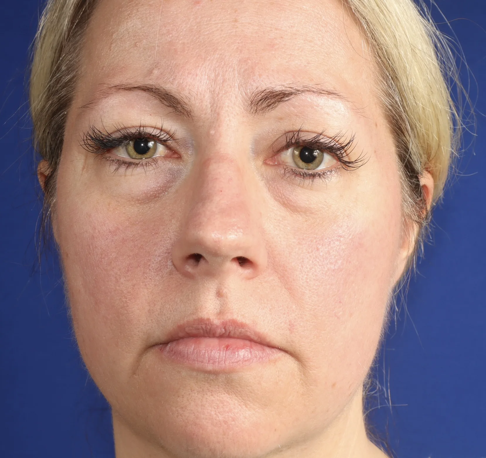 Woman with blonde hair facing forward against blue background, showing facial features and under-eye area