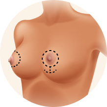 Types of Breast Lift Anchor Banner