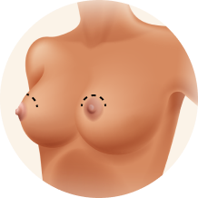 Types of Breast Lift Crescent Banner