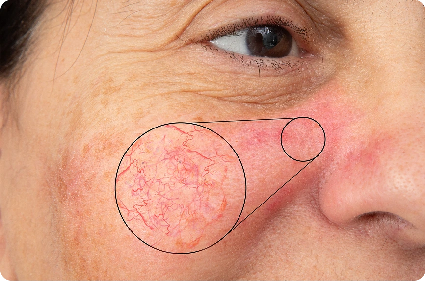 How To Get Rid Of Facial Veins And What Treatments Actually Work Banner