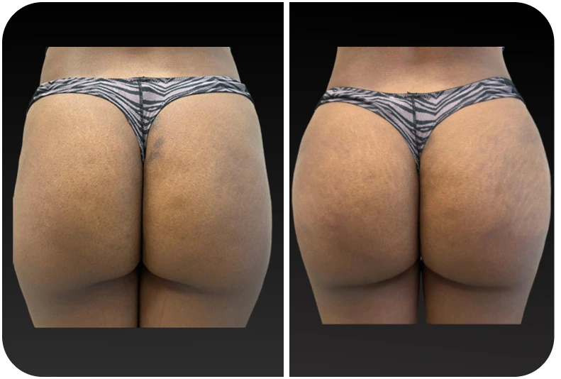 Before and after comparison of buttock augmentation results
