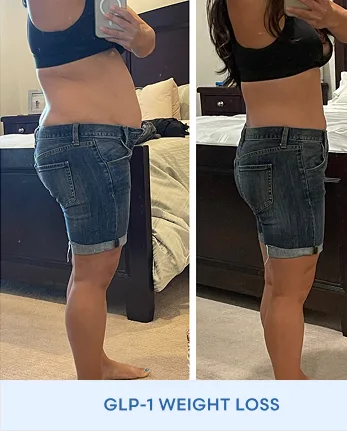 Before and after front view showing reduced midsection with GLP-1 weight loss treatment