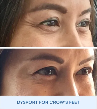 Before and after close-up of eyes showing reduced crow's feet lines with Dysport