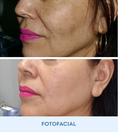 Before and after facial treatment showing reduced wrinkles and improved skin texture, labeled Fotofacial