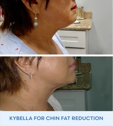 Before and after side profile showing reduced chin fullness with Kybella for chin fat reduction