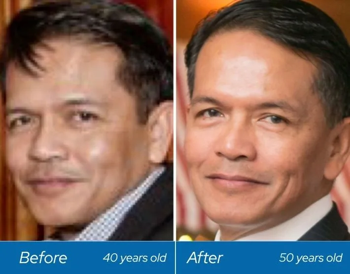 Before and after dermal filler results on male patient at ages 40 and 50