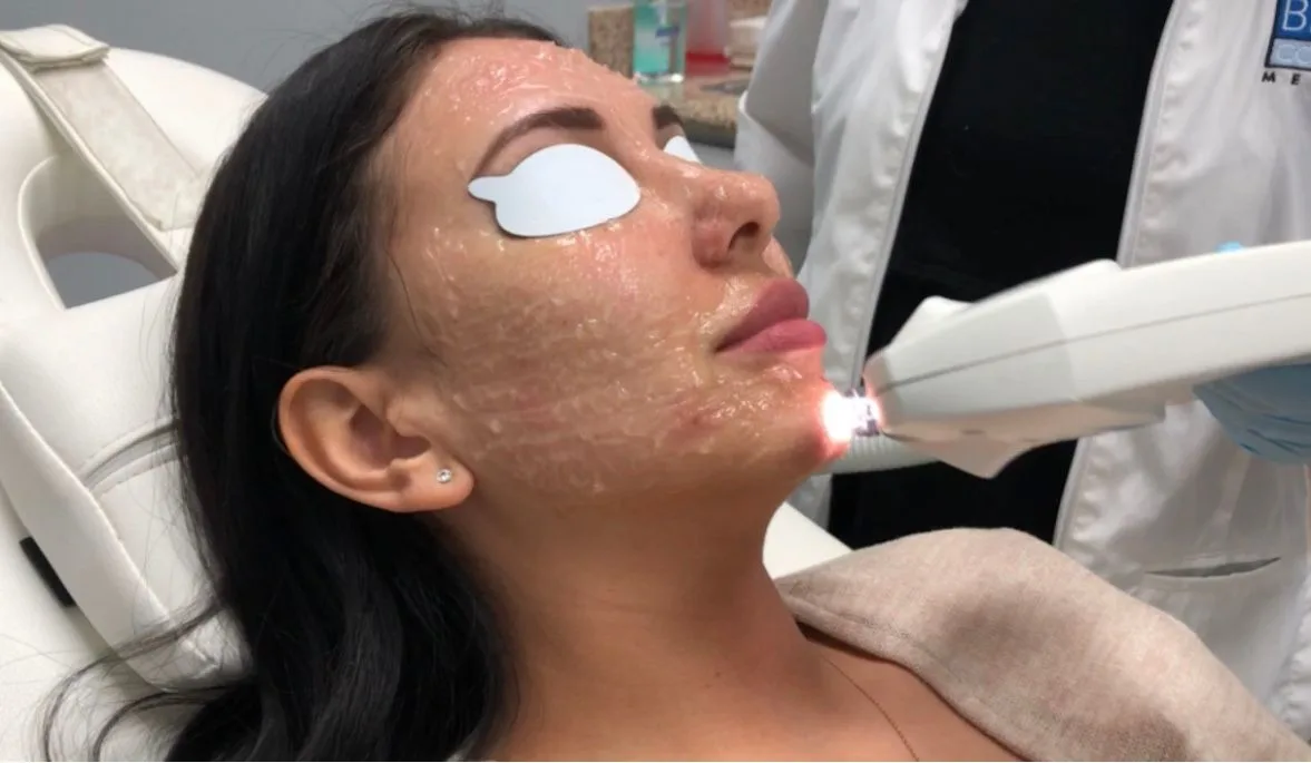 FotoFacial Treatment Los Gatos, CA Banner
