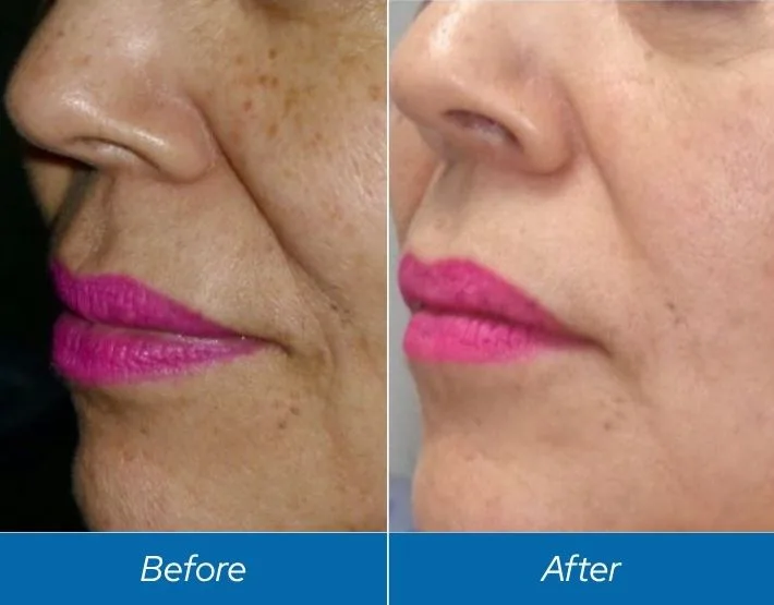Before and after Fotofacial showing reduced age spots and improved skin tone