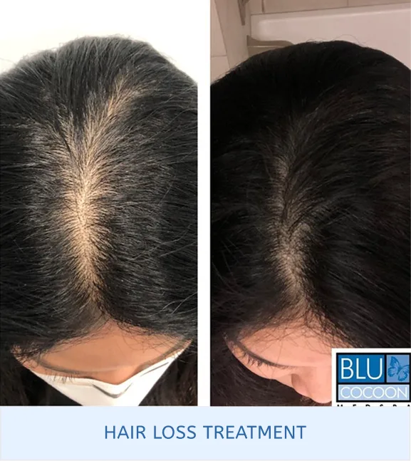 Before and after hair loss treatment showing increased scalp coverage and darker hair appearance