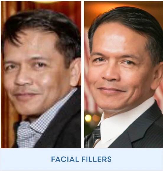 Before and after facial fillers treatment results on male patient