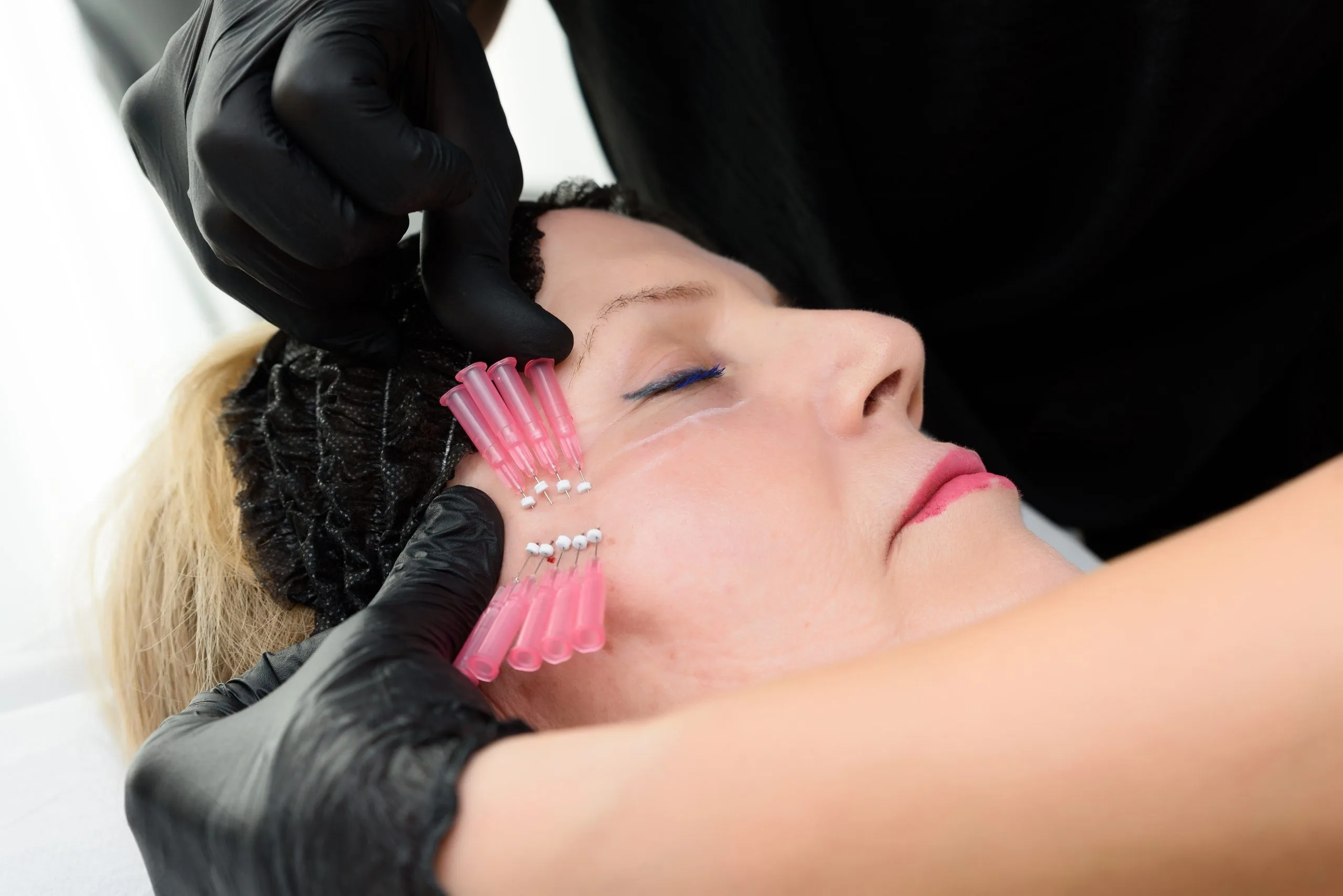 How Do PDO Threads Work? Key Insights for Skin Lifting Banner