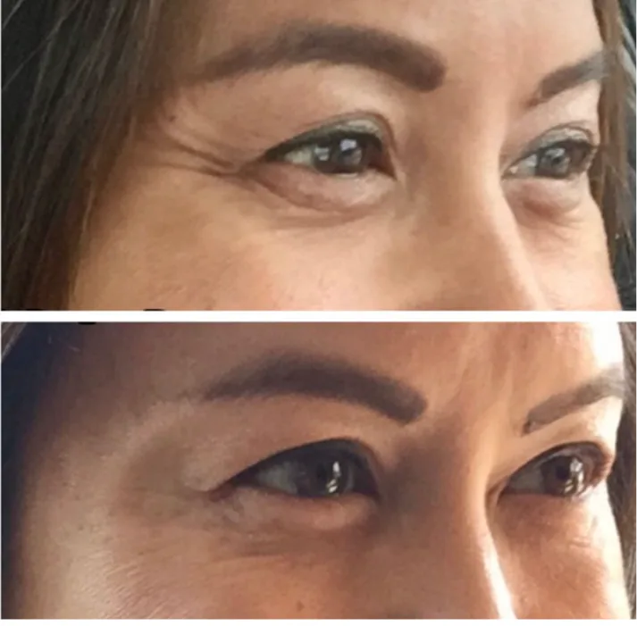Injectable Treatments Los Gatos, California Banner