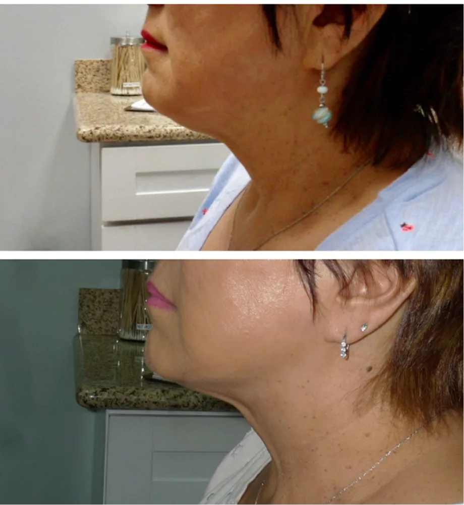 Before and after comparison showing reduction of submental fullness under the chin from Kybella treatment