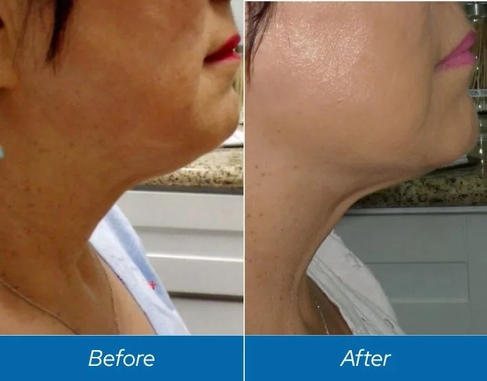 Before and after Kybella treatment showing reduced under-chin fullness