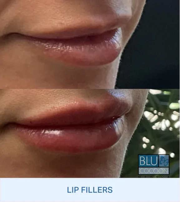 Before and after comparison of fuller lips from lip filler treatment