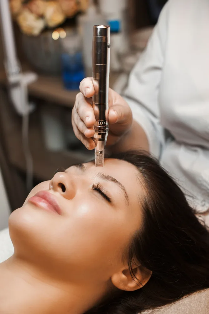 Microneedling in Los Gatos, California Banner