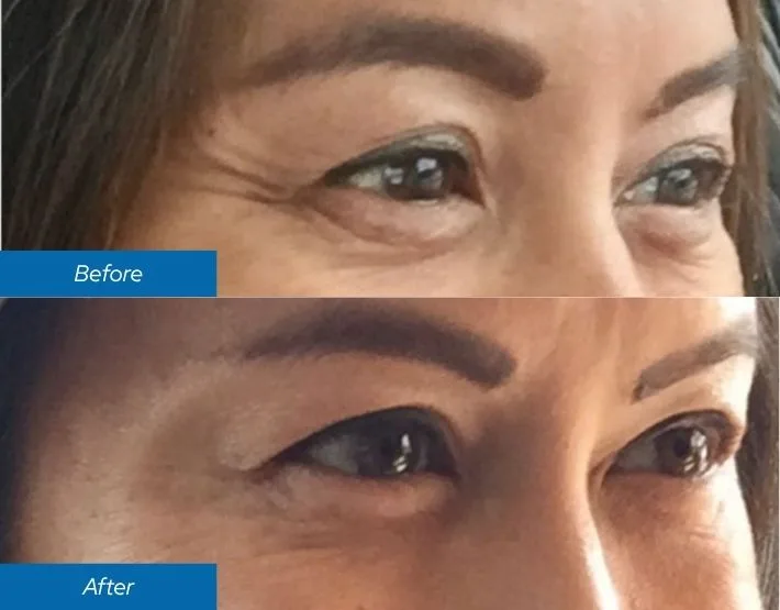 Close-up before and after comparison of woman's eye area showing reduced crow's feet and wrinkles after neurotoxin treatment