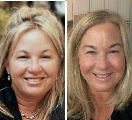 Before and after comparison of woman's face showing smoother forehead and reduced expression lines