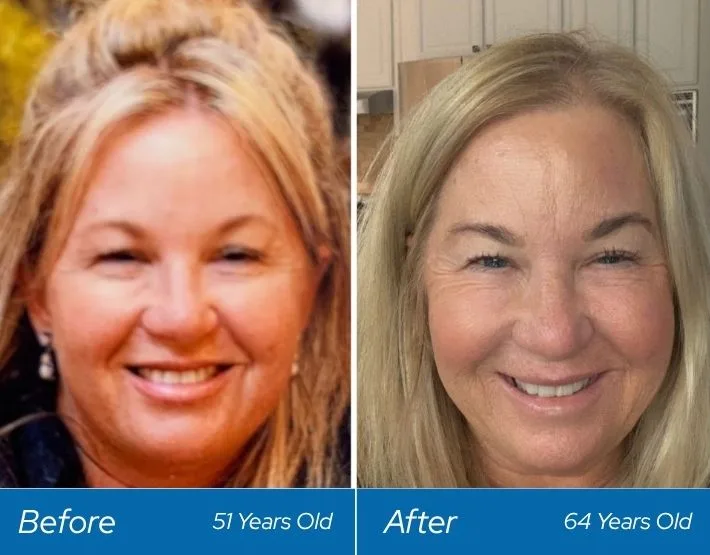 Before and after facial comparison of woman at age 51 and 64 showing reduced forehead wrinkles after neurotoxin treatment