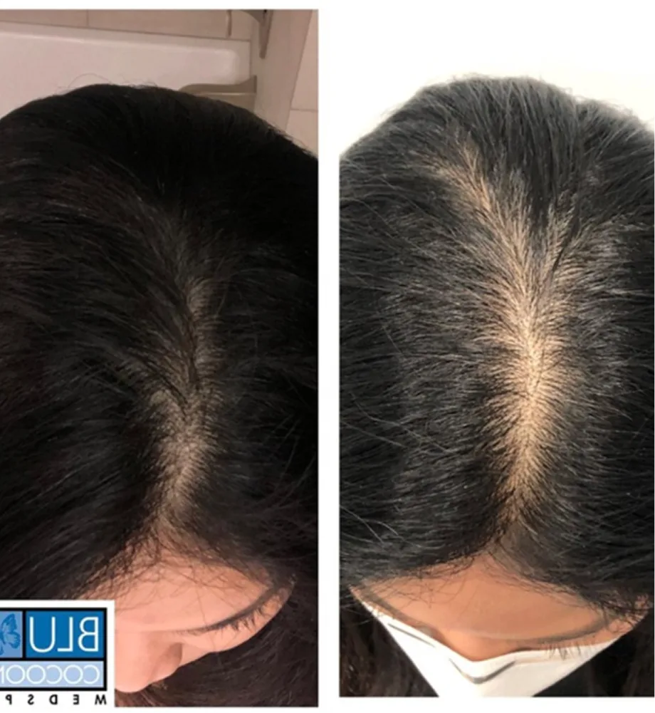 Before and after scalp comparison showing increased hair density and reduced hair loss