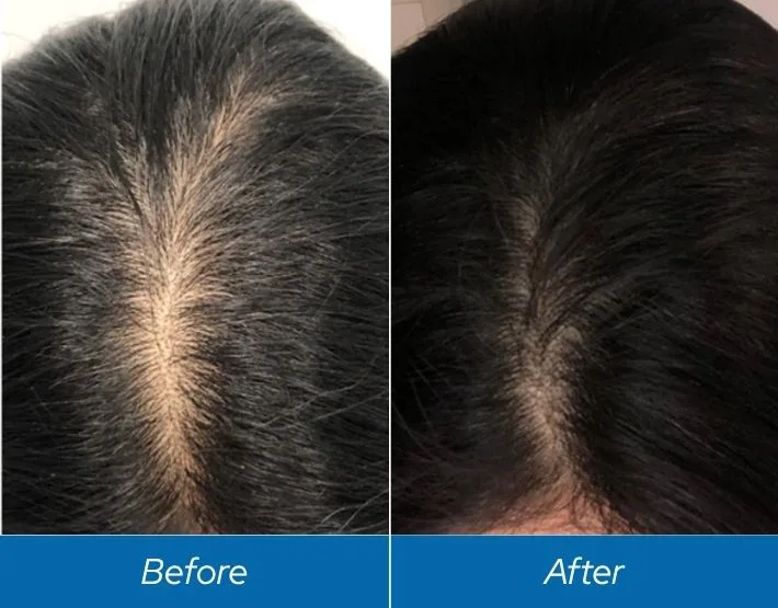 Before and after PRF hair treatment showing increased hair density at scalp