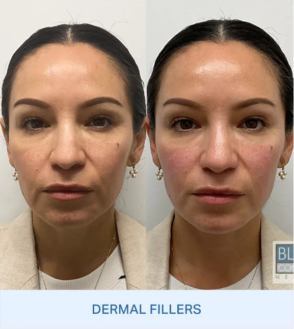 Before and after frontal facial views showing improved skin texture and volume after dermal fillers