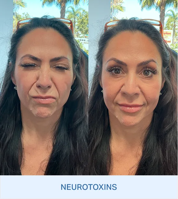 Before and after frontal face comparison showing Neurotonics results