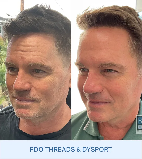 Before and after side profile comparison showing PDO Threads & Dysport results