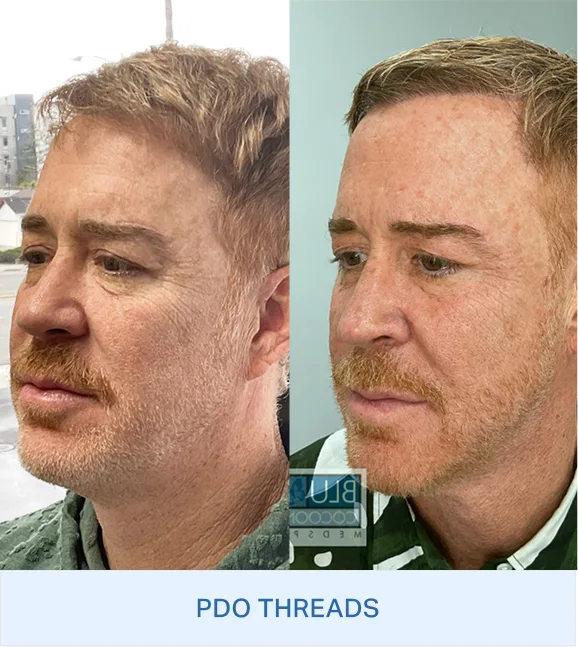 Before and after side profile comparison showing PDO Threads results