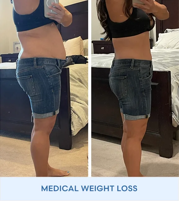 Before and after comparison of abdominal weight loss results showing reduced midsection in fitted jeans