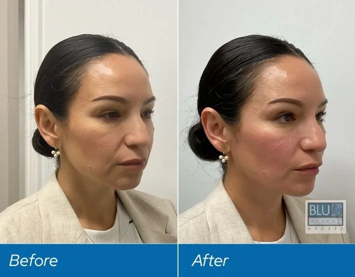 Before and after comparison of woman's face showing results from filler treatment