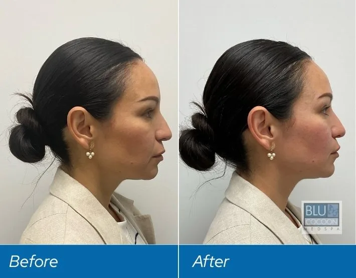 Woman's profile before and after filler treatment, showing improved cheekbone projection and chin definition