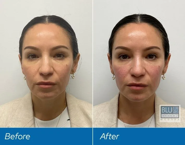 Woman's face before and after filler treatment, showing fuller cheeks and refined facial contours