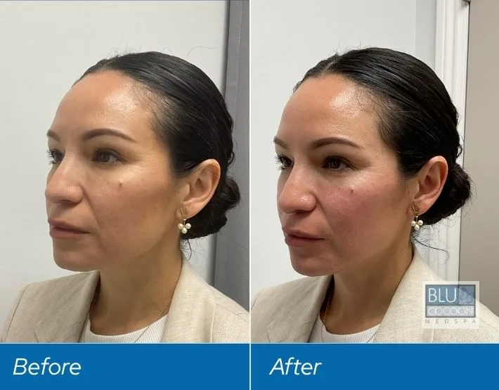 Woman's profile before and after filler treatment, showing enhanced cheek volume and facial balance