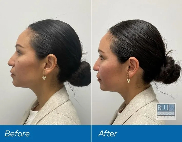Woman's profile before and after filler treatment, showing improved jawline and cheekbone definition