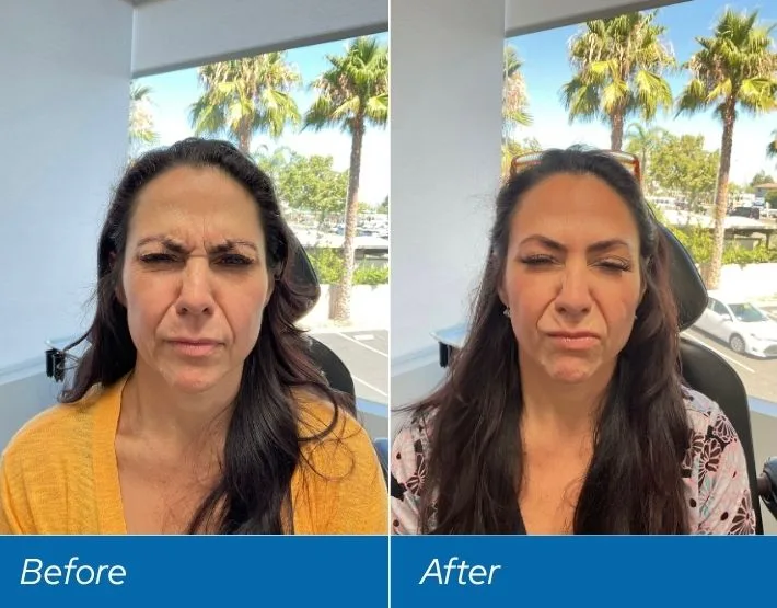 Before and after facial comparison showing softened expression lines, labeled Before and After