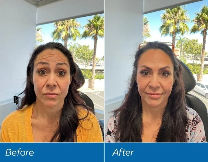 Before and after facial comparison showing reduced forehead wrinkles, labeled Before and After