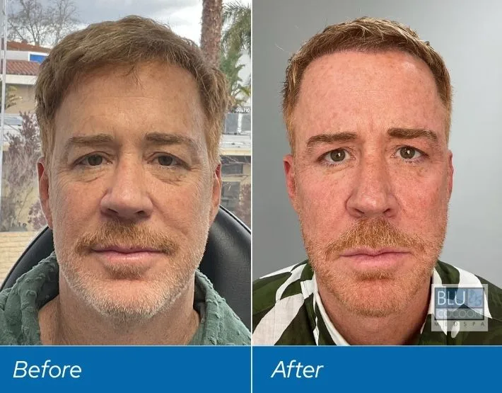Before and after comparison of man's face showing results from PDO threads treatment