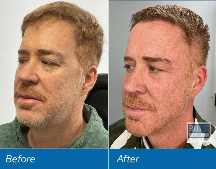 Before and after side profile comparison of man's face showing results from PDO threads treatment