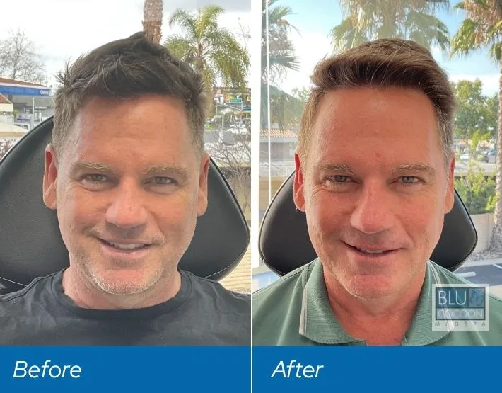 Before and after comparison of man's face showing results from PDO threads and neurotoxin treatment