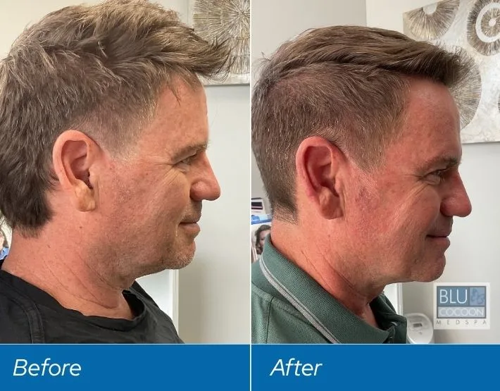 Before and after side profile comparison of man's face showing results from PDO threads and neurotoxin treatment