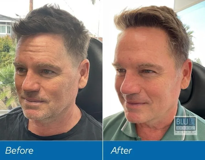 Before and after profile comparison of male patient showing refined facial contours, labeled Before and After