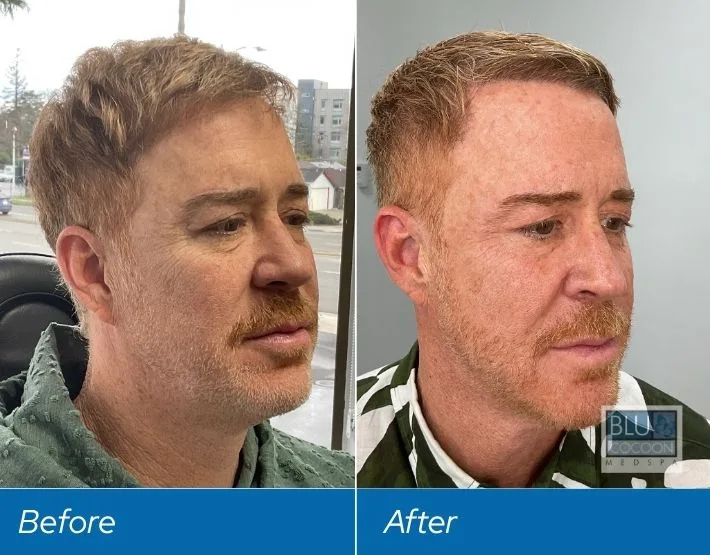 Man's face before and after PDO thread treatment, showing improved jawline definition and skin tightness