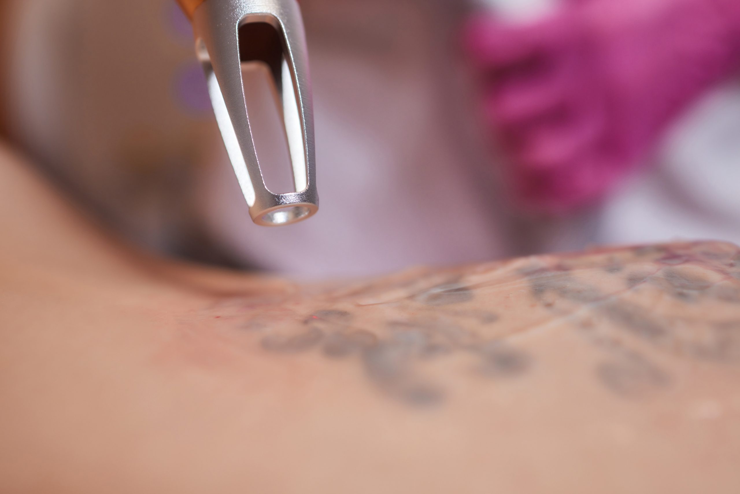 Pico vs Nanosecond Lasers for Tattoo Removal Banner