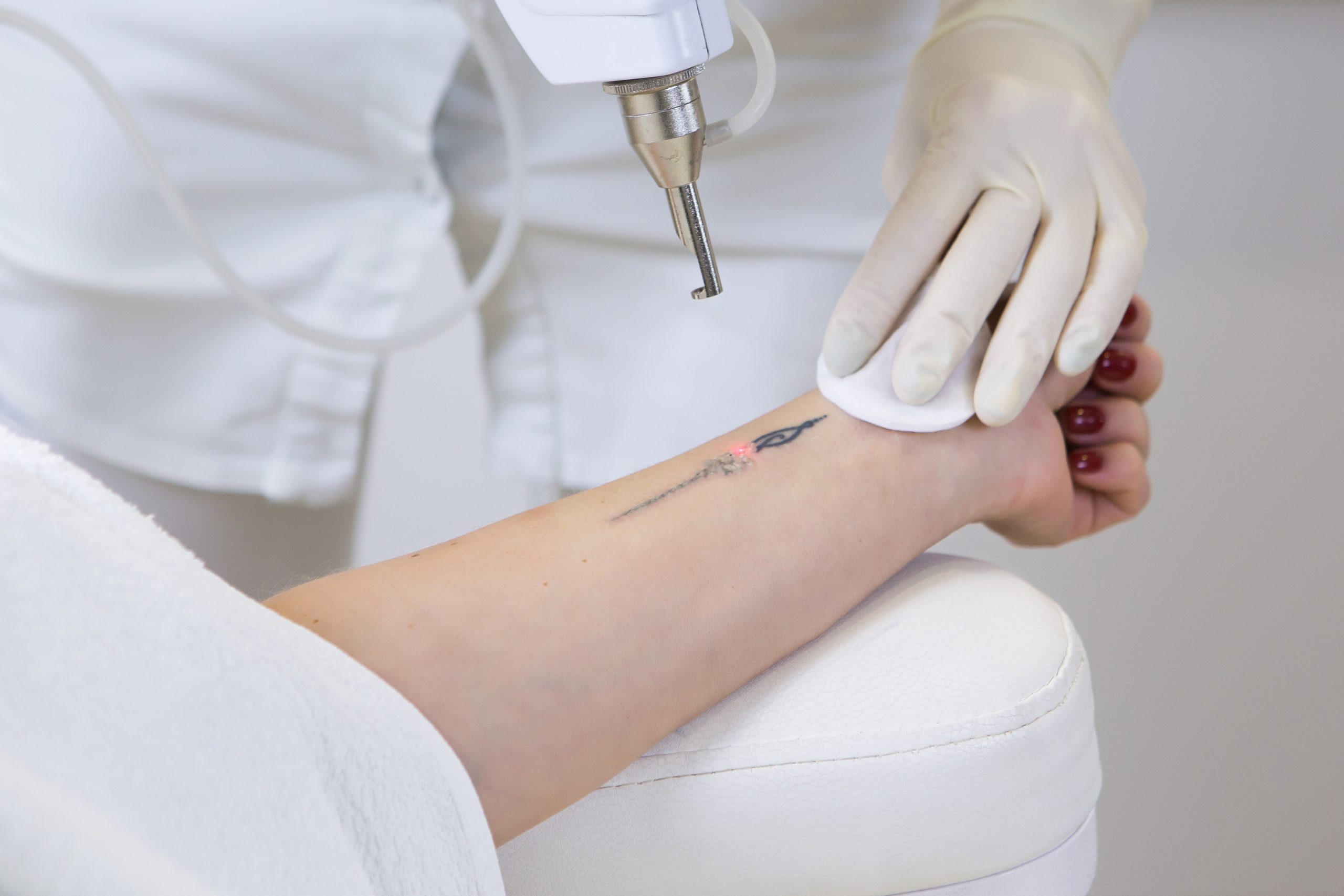 How Much Does Laser Tattoo Removal Cost in NJ? Banner