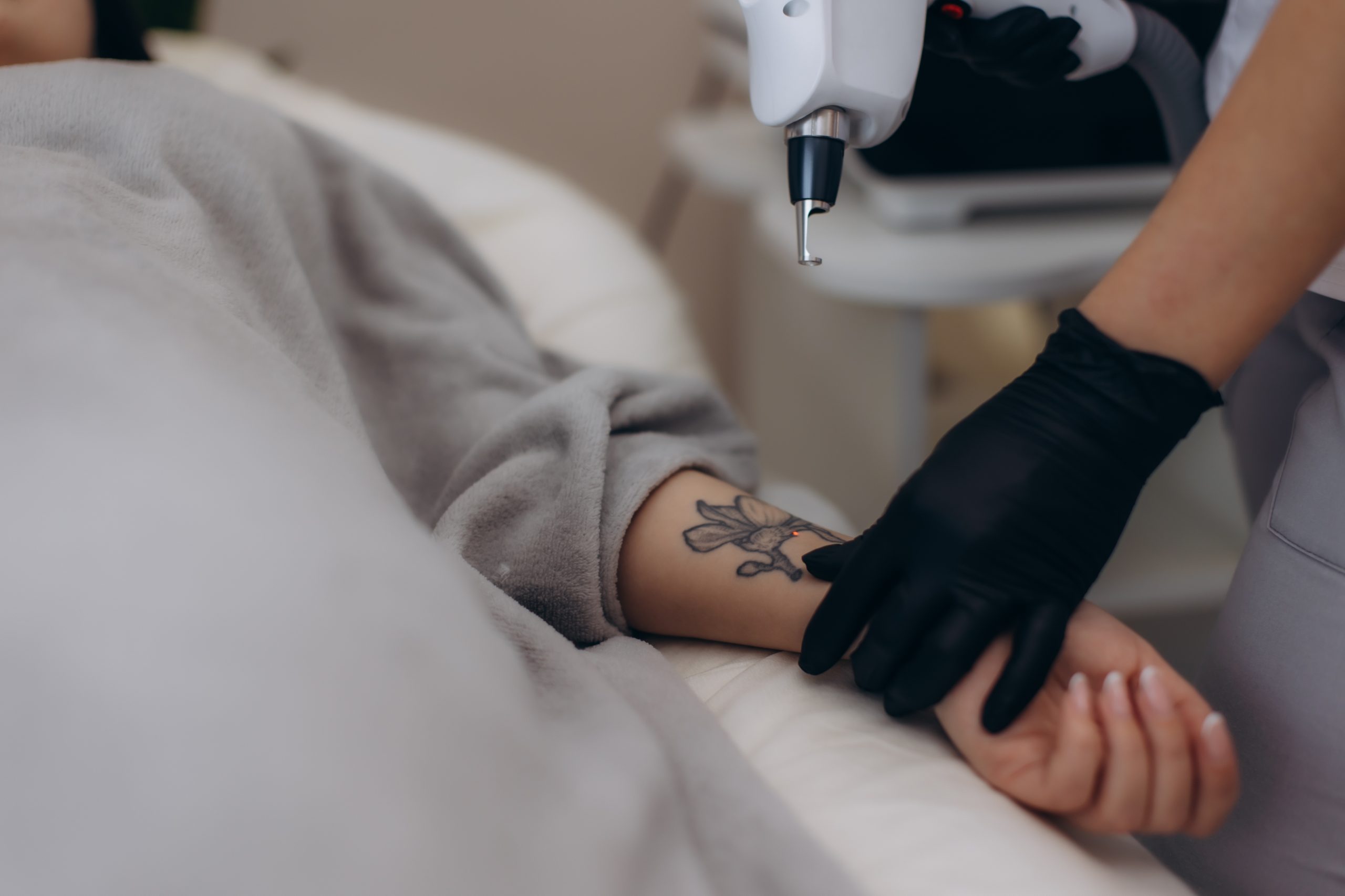 Practitioner using laser device on patient's tattooed forearm during removal treatment