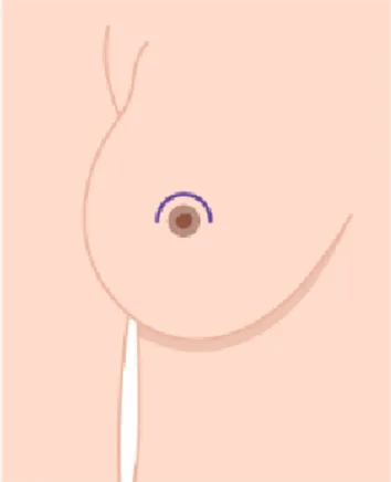 Diagram of breast showing crescent-shaped surgical incision pattern for lift procedure